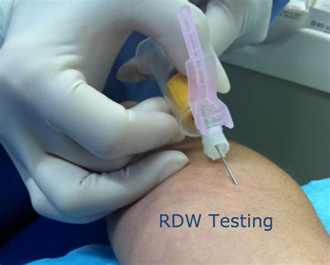 High RDW Blood Test Results? - Important Things You Need to Know Now