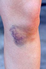 Contusion - Sinew Therapeutics