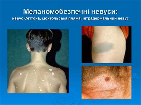 Злоякісні пухлини шкіри - презентация онлайн