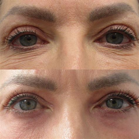 Laser Co2 Pálpebras Antes E Depois - CO2 Laser Before and After Photos • Dr. Cameron Rokhsar