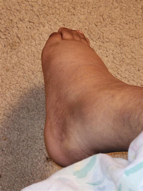 What Is A Grade 3 Ankle Sprain at Aron Desrochers blog