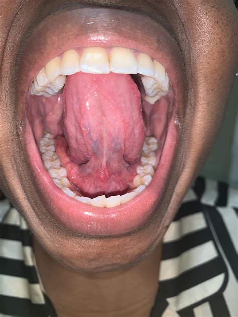 Normal Bottom Of Tongue Healthy Tongue: Pictures, Conditions,