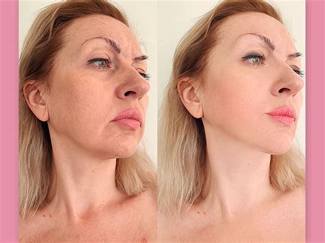 Sculptra Antes E Depois Rosto - Sculptra - O que é, preço e resultados | Dream Plastic