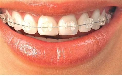 invisible braces invisalign clear aligners  ultimate guide