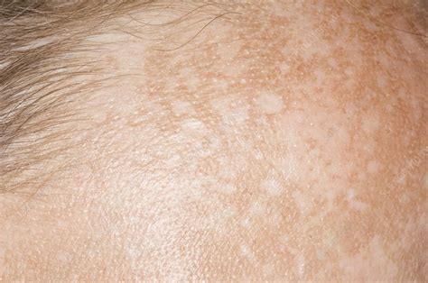 Chloasma skin patches - Stock Image - C004/4241 - Science Photo Library