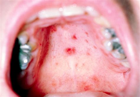Hand,Foot & Mouth disease: blisters … – Bild kaufen – 11839522 Science ...