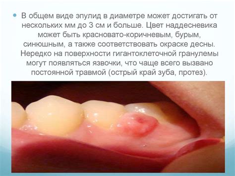 Эпулис - презентация онлайн
