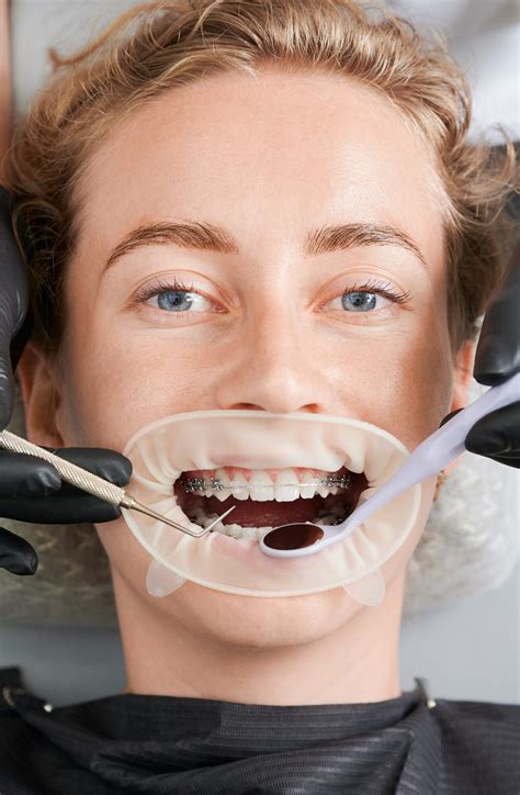 how much can braces cost with insurance 1