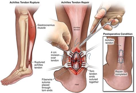 Achilles Tendon Tear