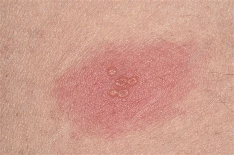 Shingles rash - Stock Image - C047/3051 - Science Photo Library