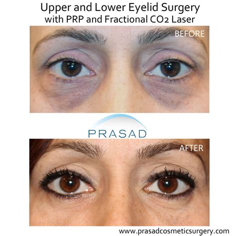 Eyelid Retraction: What It Is, Why It Happens, and How to Avoid It