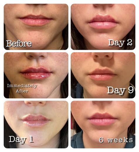 lip filler swelling timeline infoupdateorg