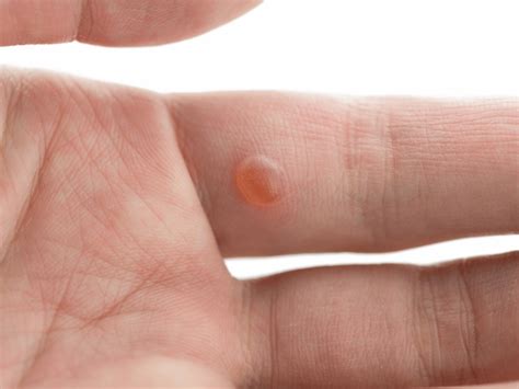 common hand warts   infoupdateorg