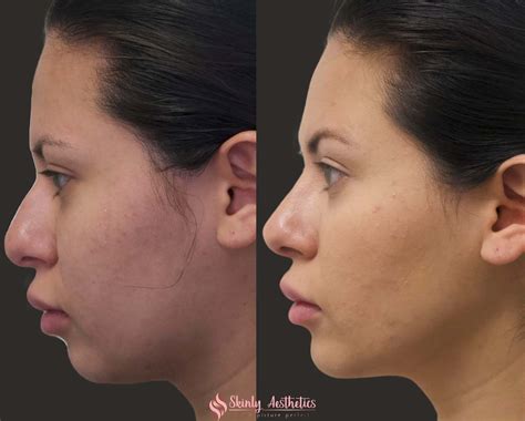 Non-Surgical Rhinoplasty - Before and After Results