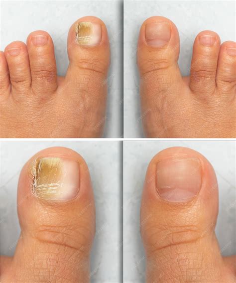 Premium Photo | Before and after successful mycosis treatment on the