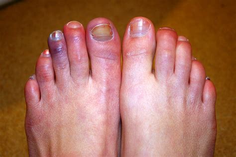 chilblains podiatry hq