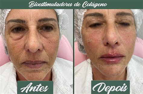 Preço Bioestimulador De Colageno - Bioestimulador de Colágeno Injetável - Preço Bom é na Dellavi