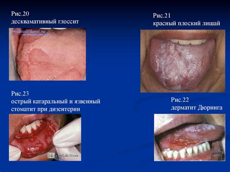 Заболевания слизистой оболочки полости рта - презентация онлайн