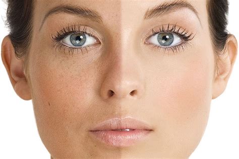 how to fix uneven skin tone on face