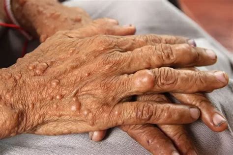 Что такое нейрофиброматоз? Генетическое заболевание, унесшее жизнь Ника ...