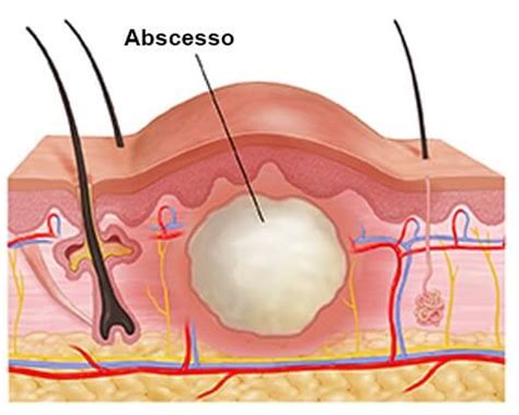 O Que E Um Abscesso