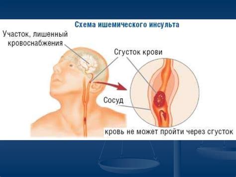 Инсульт. Статистика инсульта - презентация онлайн