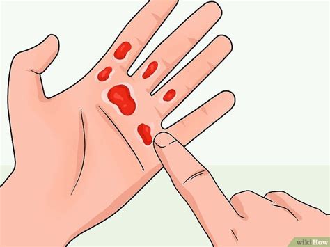 Возможно вы не знали , но реакция льда и соли , даст химический ожог на ...