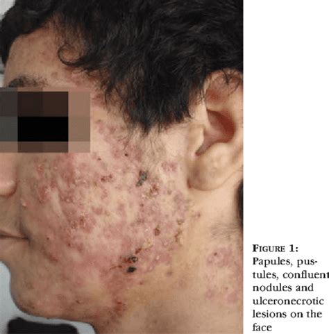 [PDF] Disabling Acne Fulminans * Acne fulminans incapacitante ...