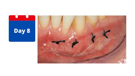 The different healing stages of a gum graft (Day by Day Pictures)