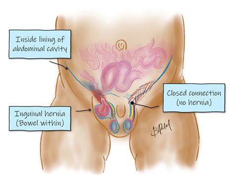 Inguinal Hernia Male Complications Of Prosthetic Mesh Repair