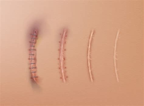 sutures images  vectors stock  psd