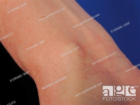 Synovial cyst of the wrist, Stock Photo, Picture And Rights Managed ...