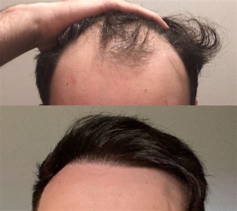 Venus Hair Restoration | Michigan's most experienced and affordable