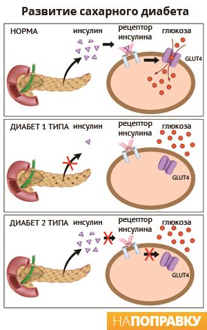 Сахарный диабет: симптомы и признаки – НаПоправку