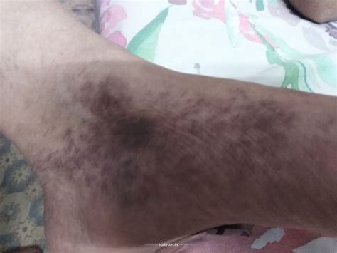 Ask a Dermatologist Online for Dark Spots On Feet