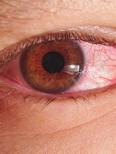 dark urine  reasons   urine  dark  colour