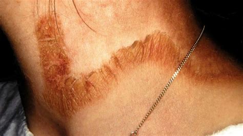 pellagra  symptoms  effective home remedies healthtian