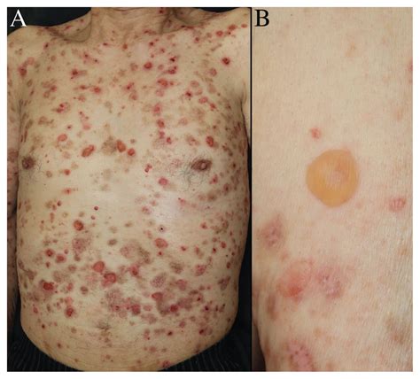 Bullous Pemphigoid