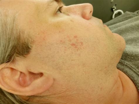 Got this cluster pimple-like bumps on the side of my face that's