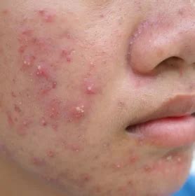 Teenage Acne | Skin Concerns | The Éterne Clinic