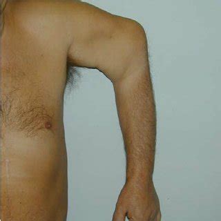 B. Clinic view with a new joint (non-union) upper the elbow | Download ...