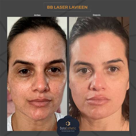 Lavieen Antes E Depois Olheiras