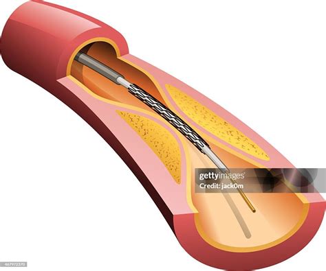 stent  artery high res vector graphic getty images