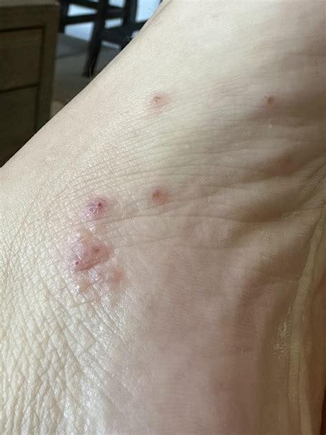Couldn’t resist popping my foot. One was yellow inside, the others were