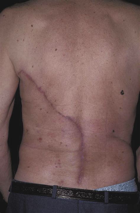 reverse turnover latissimus dorsi flap  closure  midline
