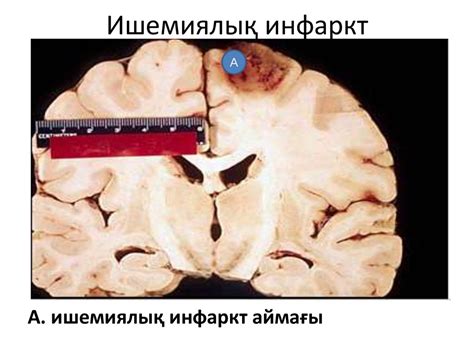 Цереброваскулярлы аурулар - презентация онлайн