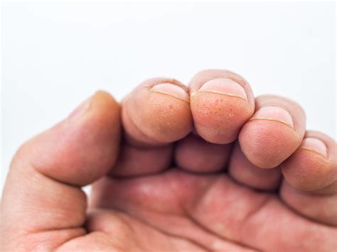 How Do You Get Rid Of Dyshidrotic Eczema? – Balmonds