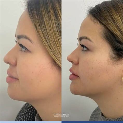 Armonización Facial I ¿Qué es y cuáles son sus beneficios?