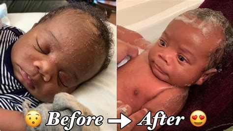 A Parent's Guide To Infantile Acne Baby Acne - UsParenting.com