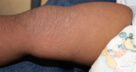 how to treat skin rash from bactrim
